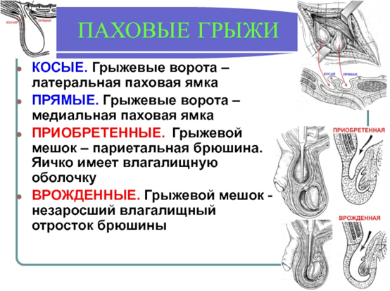 Паховая грыжа рисунок